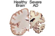 Alzheimers brain